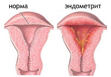 Отзывы пациентов прооперированных с эндометриозом